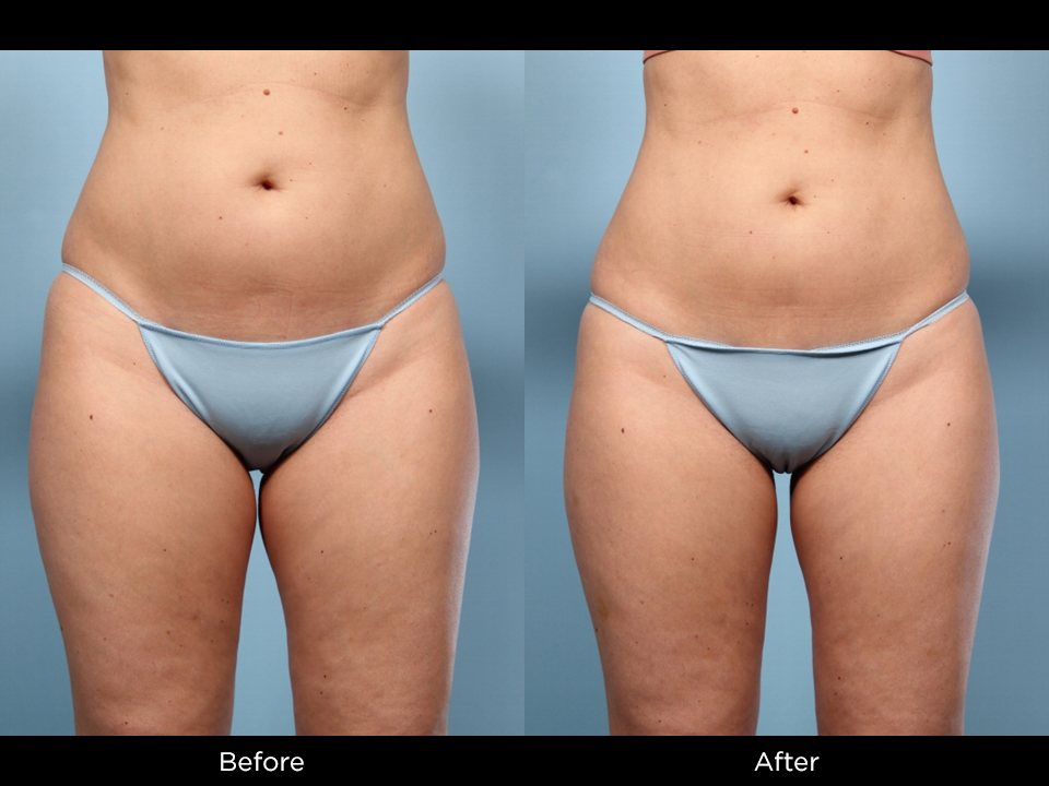 кріоліполіз стегон результат