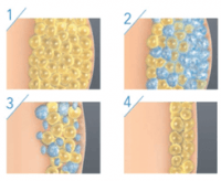 як працює кріоліполіз як працює кріоліполіз