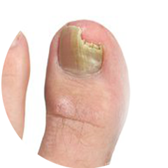 Лікування нігтьового грибка 5 косметологія у Івано-Франківську FineLine Лікування нігтьового грибка - 28/11/2025