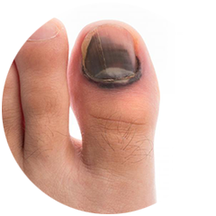 Лікування нігтьового грибка 7 косметологія у Івано-Франківську FineLine Лікування нігтьового грибка - 28/11/2025