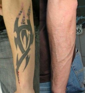 ЛАЗЕРНА ЕПІЛЯЦІЯ 22 лазерне видалення тату