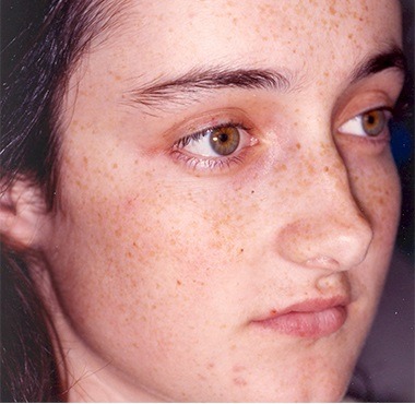 Пілінг 14 косметологія у Івано-Франківську FineLine ДО