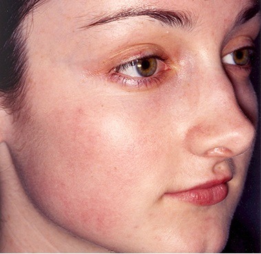 Пілінг 15 косметологія у Івано-Франківську FineLine ПІСЛЯ