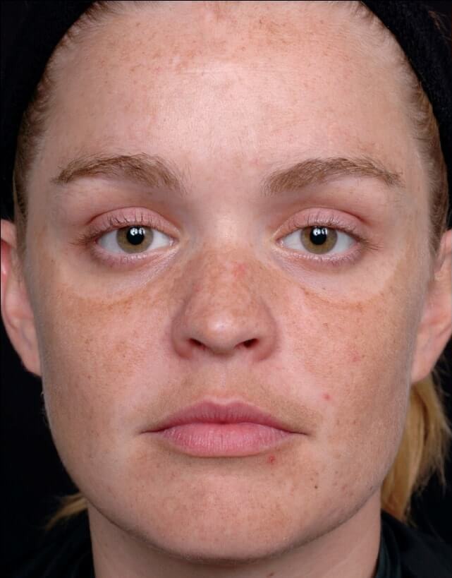 Лазерне шліфування шкіри в Івано-Франківську 8 косметологія у Івано-Франківську FineLine До