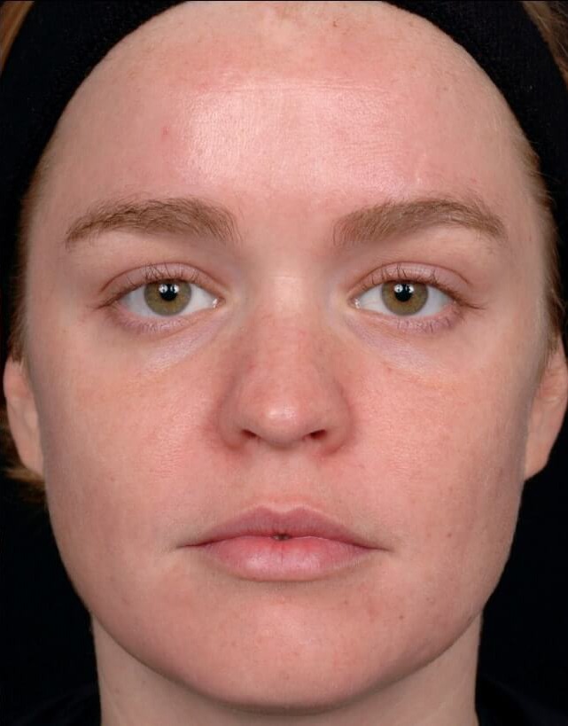 Лазерне шліфування шкіри в Івано-Франківську 9 косметологія у Івано-Франківську FineLine Результа після