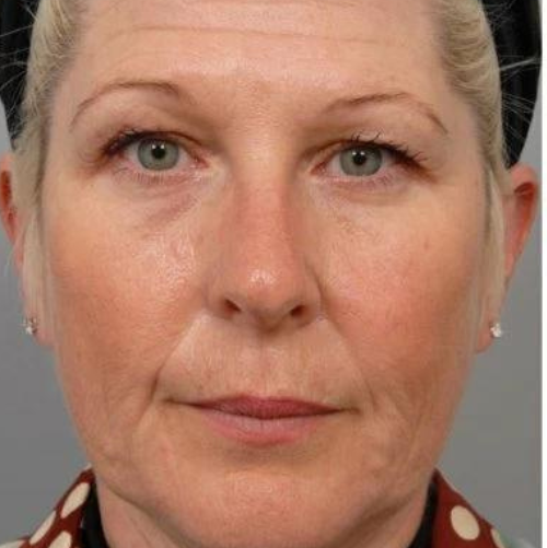 Мезотерапія 11 косметологія у Івано-Франківську FineLine Результат до проведення мезотерапії