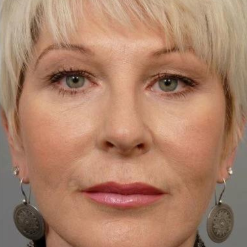 Мезотерапія 12 косметологія у Івано-Франківську FineLine Результат після проведення мезотерапії