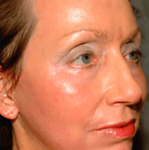 Біоревіталізація 8 косметологія у Івано-Франківську FineLine Результат після процедури біоревіталізації