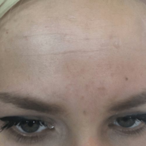 Корекція зморшок(Ксеомін) 9 косметологія у Івано-Франківську FineLine після виконання процедури ксеоміну