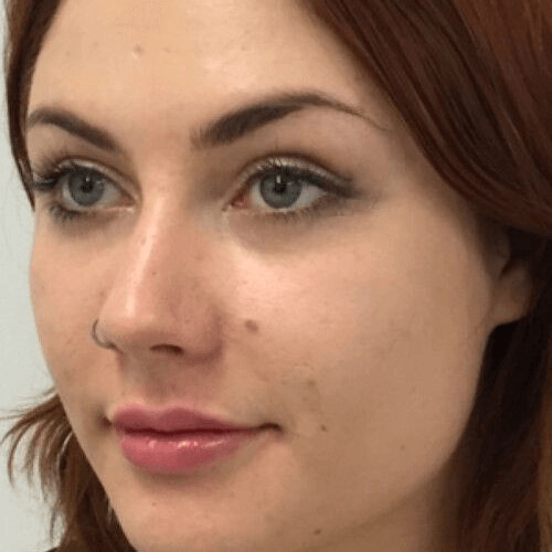 Контурна пластика 9 косметологія у Івано-Франківську FineLine після процедури контурна пластика