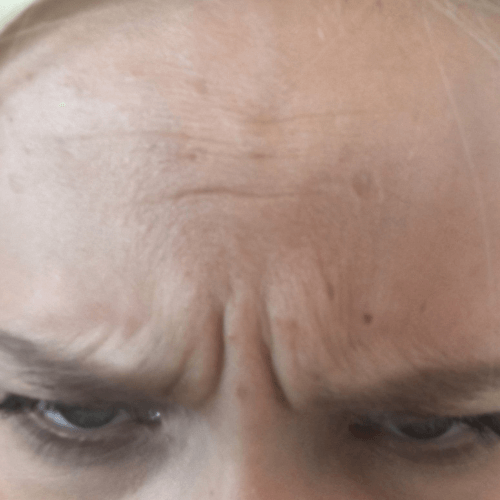 Корекція зморшок(Ксеомін) 8 косметологія у Івано-Франківську FineLine до виконання процедури ксеоміну