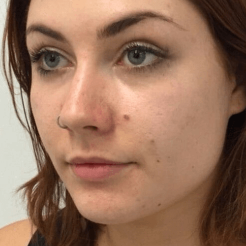 Контурна пластика 8 косметологія у Івано-Франківську FineLine до процедури контурна пластика