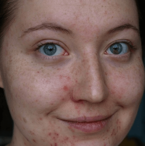 ЧИСТКА ОБЛИЧЧЯ 8 косметологія у Івано-Франківську FineLine Результат після чистки обличчя