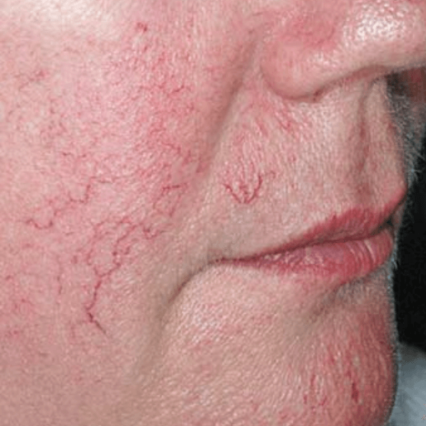 Лазерне видалення судин 8 косметологія у Івано-Франківську FineLine До продення лазерного видалення судин