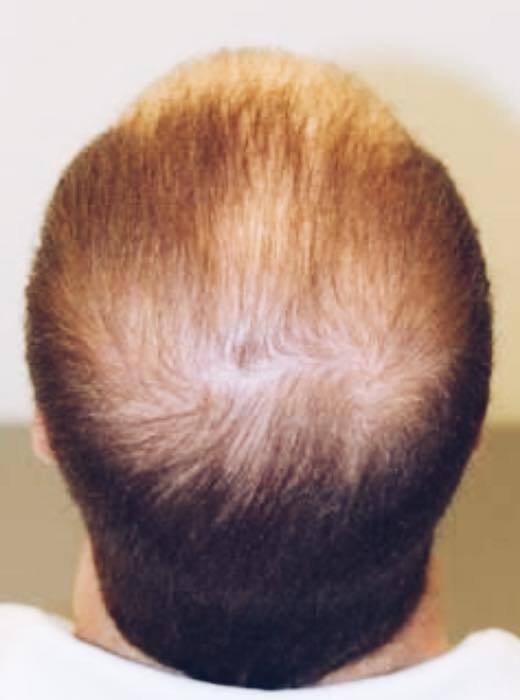 Лікування випадіння волосся 8 косметологія у Івано-Франківську FineLine до лікування випадіння волосся