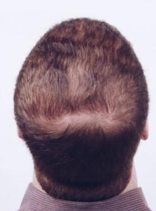 Лікування випадіння волосся 9 косметологія у Івано-Франківську FineLine після лікування випадіння волосся