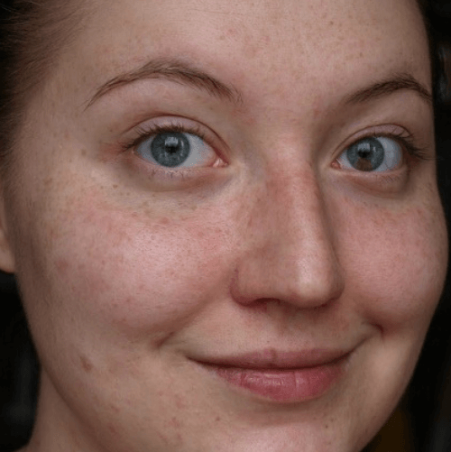 ЧИСТКА ОБЛИЧЧЯ 9 косметологія у Івано-Франківську FineLine Результат до чистки обличчя