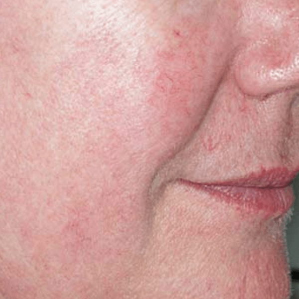 Лазерне видалення судин 9 косметологія у Івано-Франківську FineLine Результат після лазерного видалення судин