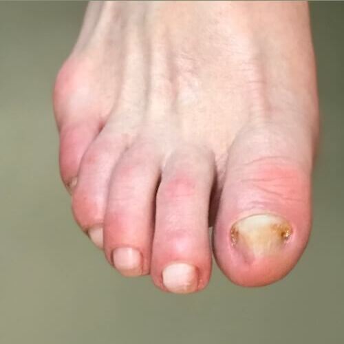 Лікування нігтьового грибка 9 косметологія у Івано-Франківську FineLine після лікування нігтьового грибка