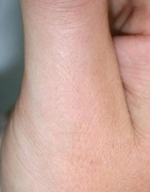 Видалення бородавок 7 косметологія у Івано-Франківську FineLine після лазерного видалення бородавки