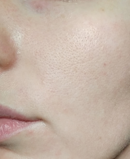 Маски для обличчя 9 косметологія у Івано-Франківську FineLine після використання маски для обличчя