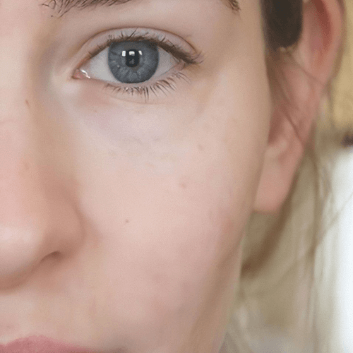 Мезотерапія обличчя 9 косметологія у Івано-Франківську FineLine після мезотерапії обличчя