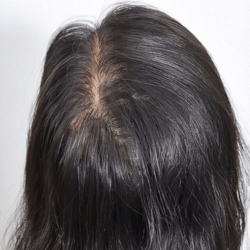 Мезотерапія волосся 9 косметологія у Івано-Франківську FineLine після виконання мезотерапії волосся