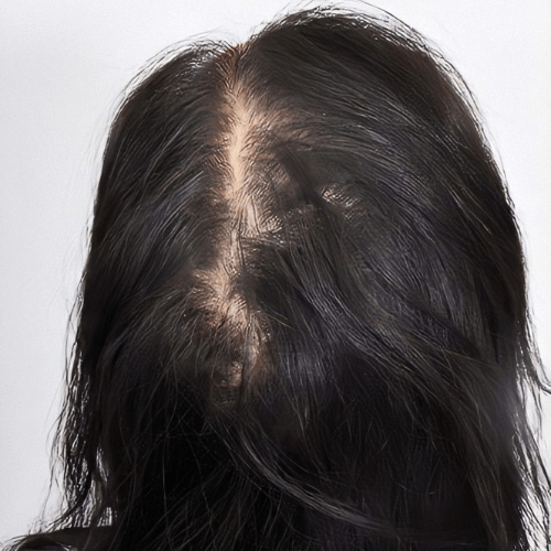 Мезотерапія волосся 8 косметологія у Івано-Франківську FineLine до виконання мезотерапії волосся