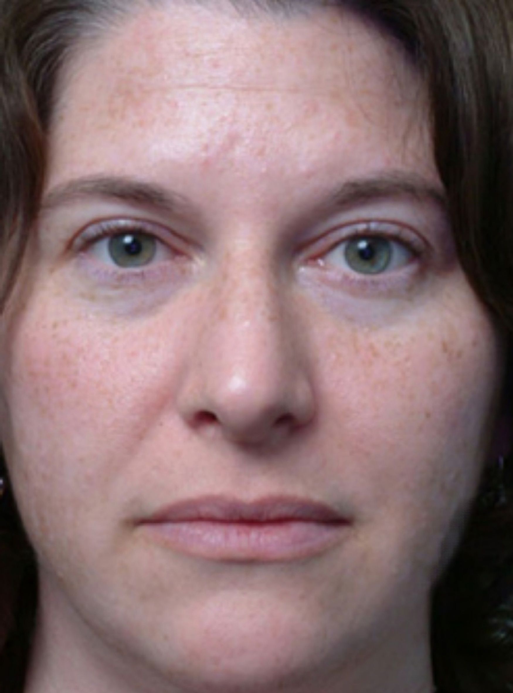 Молочний пілінг 8 косметологія у Івано-Франківську FineLine до процедури молочного пілінгу