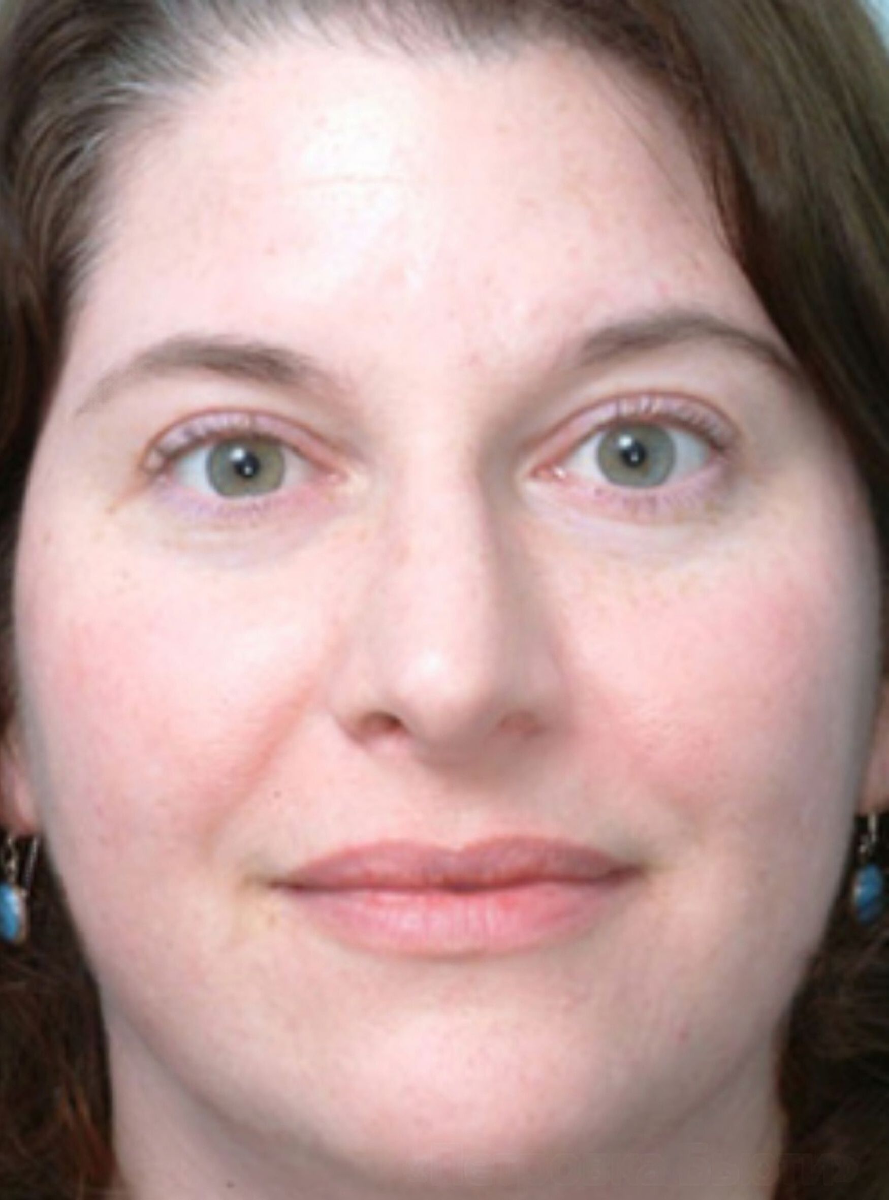 Молочний пілінг 9 косметологія у Івано-Франківську FineLine після процедури молочного пілінгу