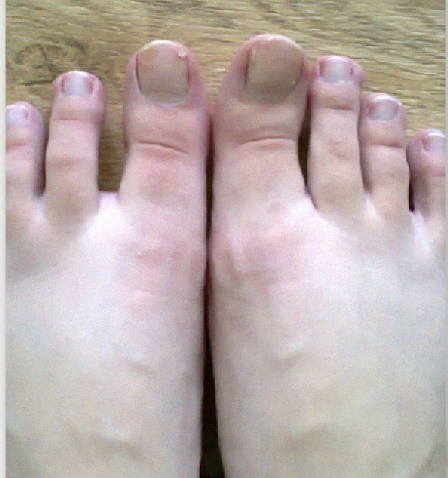 Грибок ніг 5 косметологія у Івано-Франківську FineLine до лікування грибка