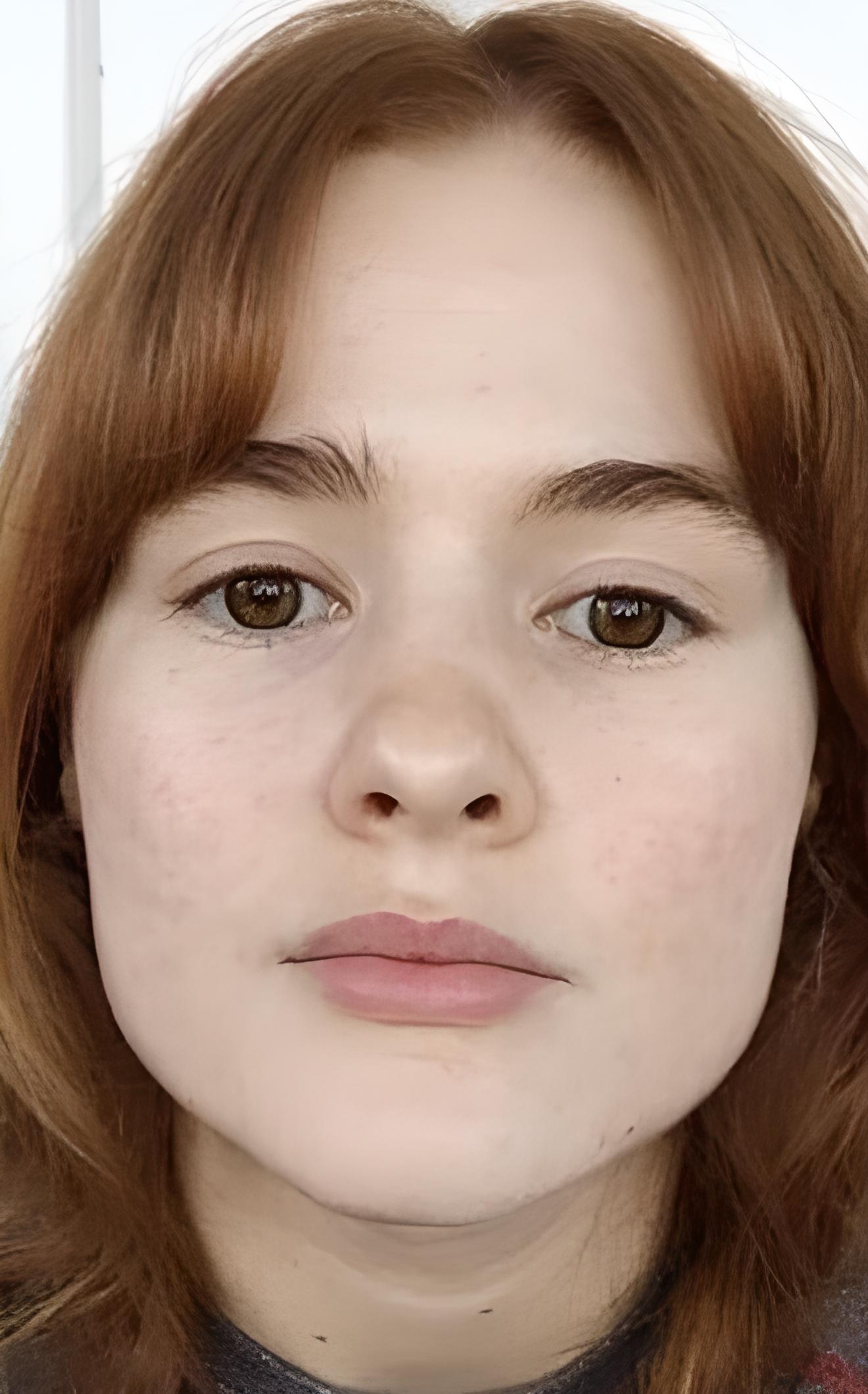 Мигдальний пілінг 9 косметологія у Івано-Франківську FineLine після процедури мигдального пілінгу