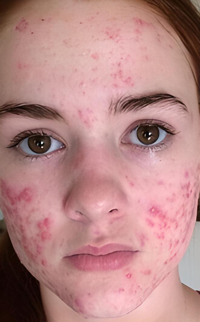 Мигдальний пілінг 8 косметологія у Івано-Франківську FineLine до процедури мигдального пілінгу