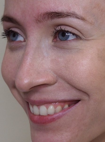 Полінуклеотиди 8 косметологія у Івано-Франківську FineLine до ін'єкції полінуклеотидами