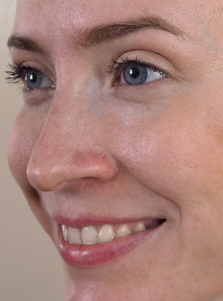 Полінуклеотиди 9 косметологія у Івано-Франківську FineLine після ін'єкції полінуклеотидами