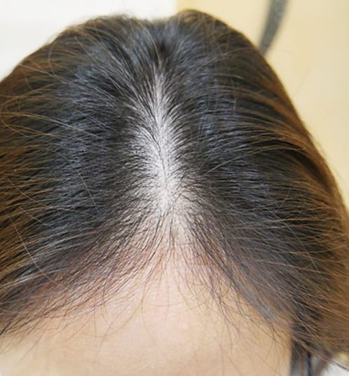 Лікування алопеції 5 косметологія у Івано-Франківську FineLine до сеансу трихології