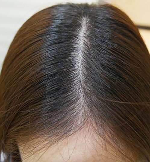 Лікування алопеції 6 косметологія у Івано-Франківську FineLine після сеансу трихології