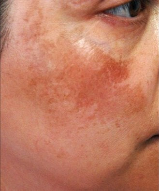 Алмазна мікродермабразія 5 косметологія у Івано-Франківську FineLine до алмазної мікродермабразії