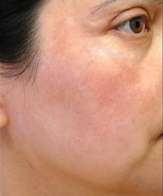 Алмазна мікродермабразія 6 косметологія у Івано-Франківську FineLine після алмазної мікродермабразії