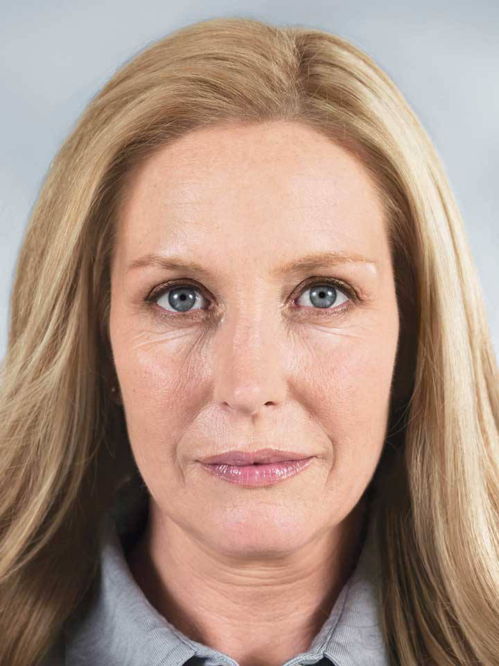 Ін'єкція ботоксу 8 косметологія у Івано-Франківську FineLine до ін'єкції ботоксу