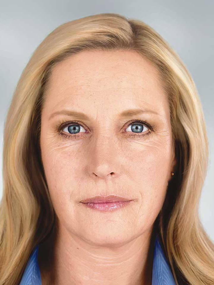 Ін'єкція ботоксу 9 косметологія у Івано-Франківську FineLine після ін'єкцій ботоксу