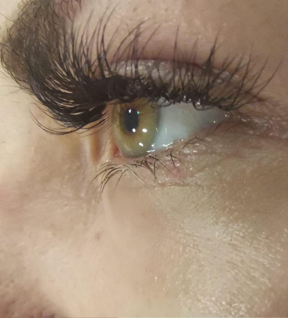 Видалення папілом 6 косметологія у Івано-Франківську FineLine після видалення папіломи