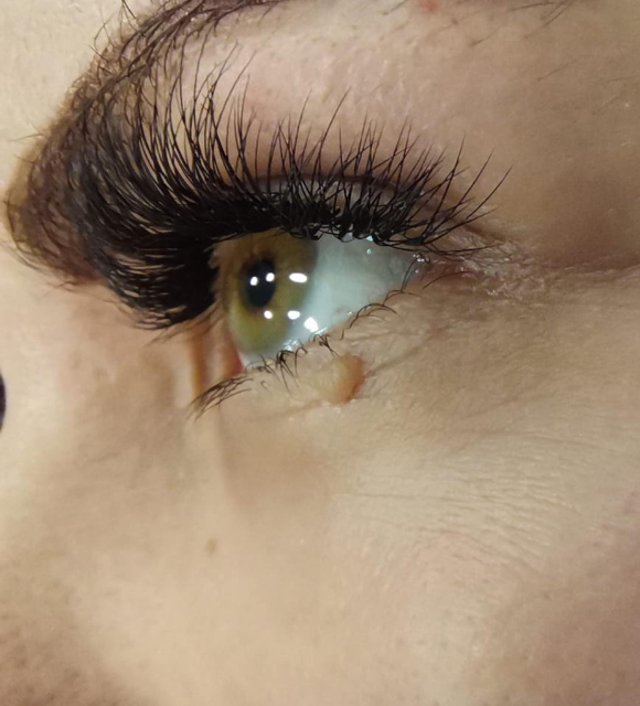 Видалення папілом 5 косметологія у Івано-Франківську FineLine до видалення папіломи