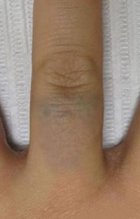 Лазерне видалення тату 9 косметологія у Івано-Франківську FineLine після лазерного видалення тату