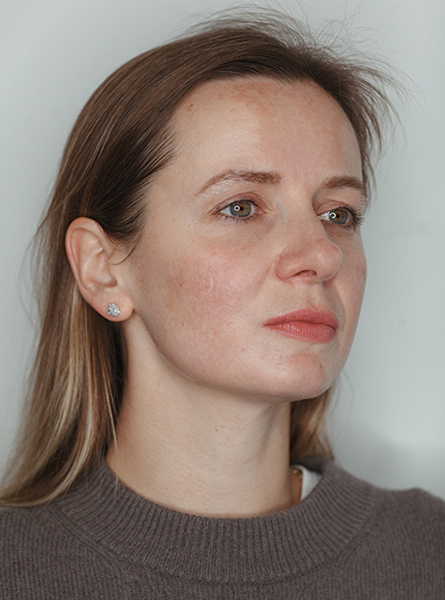 Лазерне видалення пігментних плям 8 косметологія у Івано-Франківську FineLine видалення пігментних плям до