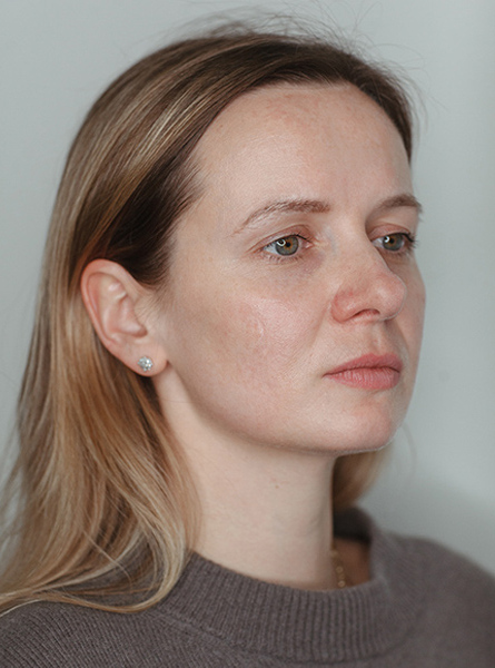 Лазерне видалення пігментних плям 9 косметологія у Івано-Франківську FineLine видалення пігментних плям після