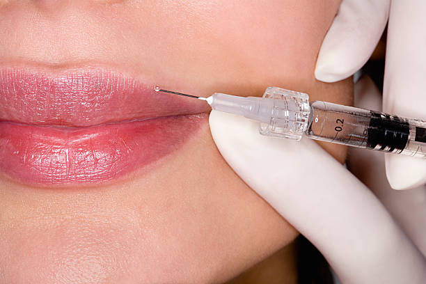 Збільшення губ: якими препаратами виконують процедуру у FineLine - 03/03/2024
