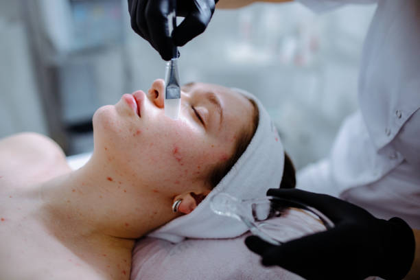 Комплексний підхід до лікування акне: від пілінгів до плазмоліфтингу 5 косметологія у Івано-Франківську FineLine Комплексний підхід до лікування акне: від пілінгів до плазмоліфтингу