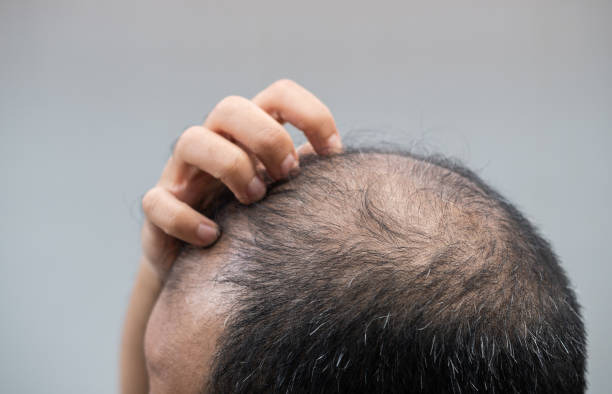 Андрогенетична алопеція: чому з’являється та чи можна її зупинити